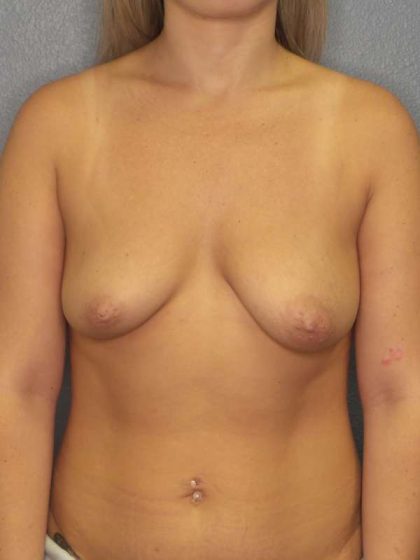 Asymmetric (Uneven) Breasts Before & After Patient #5592