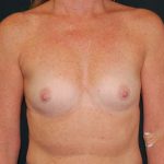 Breast Augmentation Before & After Patient #5048