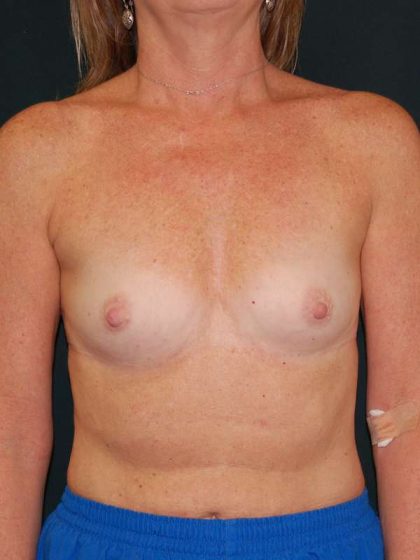 Breast Augmentation Before & After Patient #5048