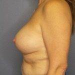 Breast Augmentation Revision (Breast Enlargement Repair) Before & After Patient #7368