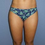 Liposuction Female Before & After Patient #8128