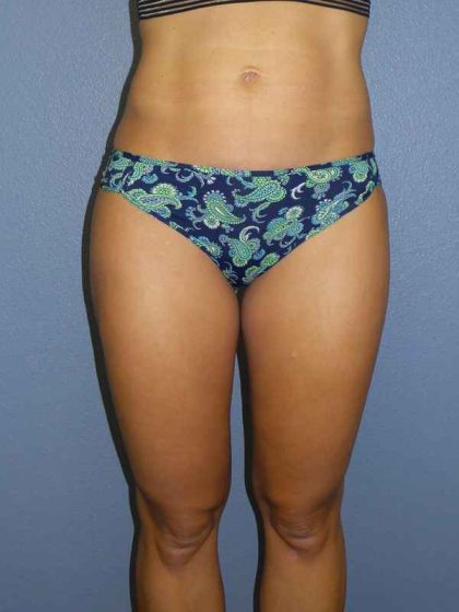 Liposuction Female Before & After Patient #8128