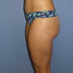 Liposuction Female Before & After Patient #8128