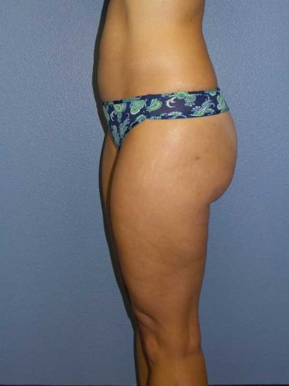 Liposuction Female Before & After Patient #8128