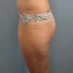 Liposuction Female Before & After Patient #8128