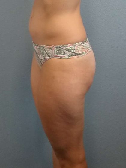 Liposuction Female Before & After Patient #8128