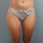Liposuction Female Before & After Patient #8128