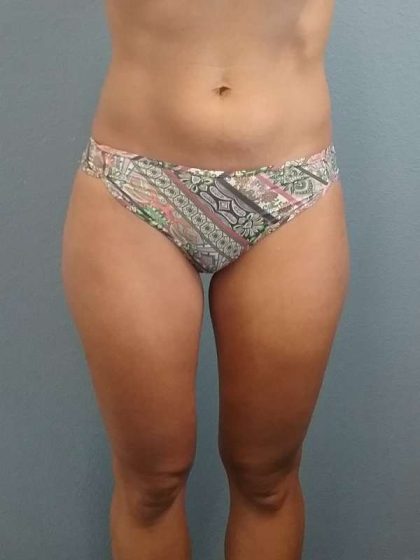 Liposuction Female Before & After Patient #8128