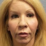 Facial Implants Before & After Patient #7588