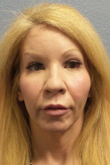Facial Implants Before & After Patient #7588
