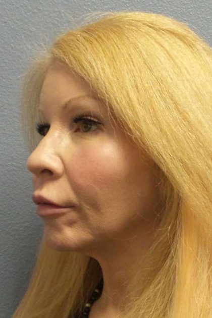 Facial Implants Before & After Patient #7588