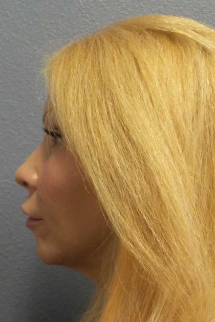 Facial Implants Before & After Patient #7588