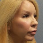 Facial Implants Before & After Patient #7588