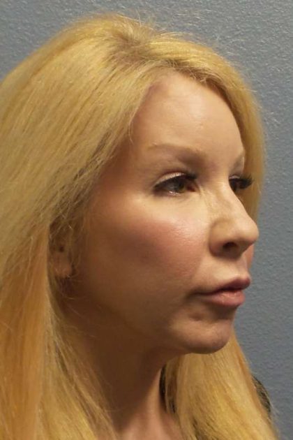 Facial Implants Before & After Patient #7588
