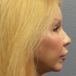 Facial Implants Before & After Patient #7588
