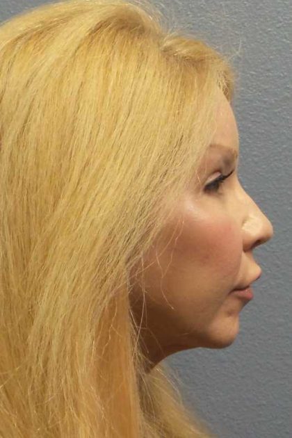 Facial Implants Before & After Patient #7588