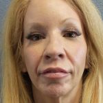 Facial Implants Before & After Patient #7588