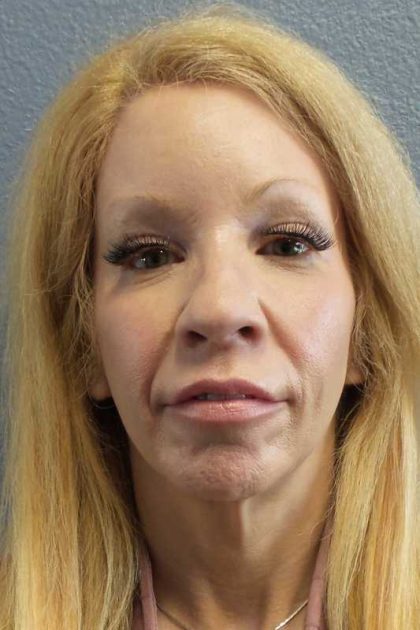 Facial Implants Before & After Patient #7588