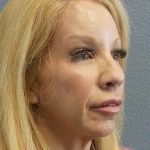 Facial Implants Before & After Patient #7588