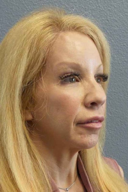 Facial Implants Before & After Patient #7588