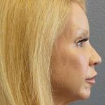 Facial Implants Before & After Patient #7588