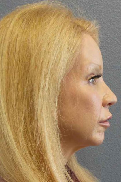 Facial Implants Before & After Patient #7588