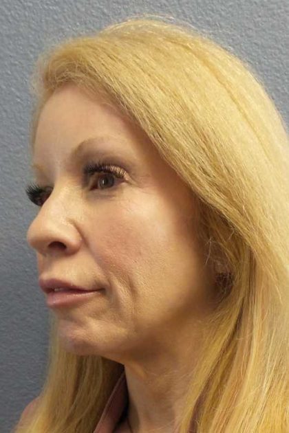 Facial Implants Before & After Patient #7588