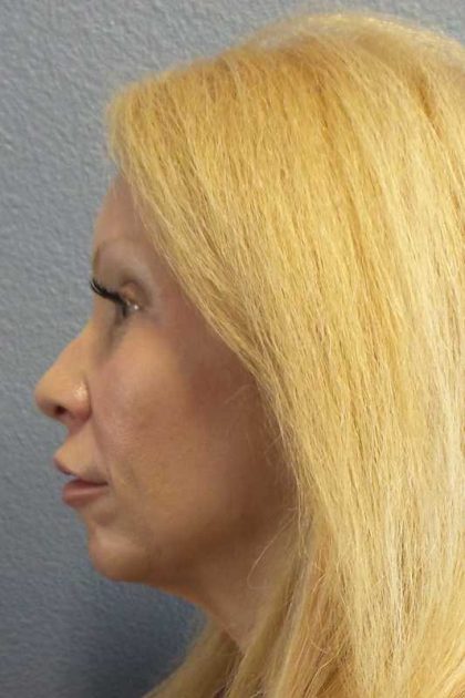 Facial Implants Before & After Patient #7588