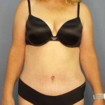 Abdominoplasty Before & After Patient #3398
