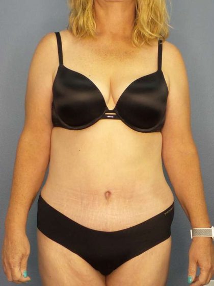 Abdominoplasty Before & After Patient #3398