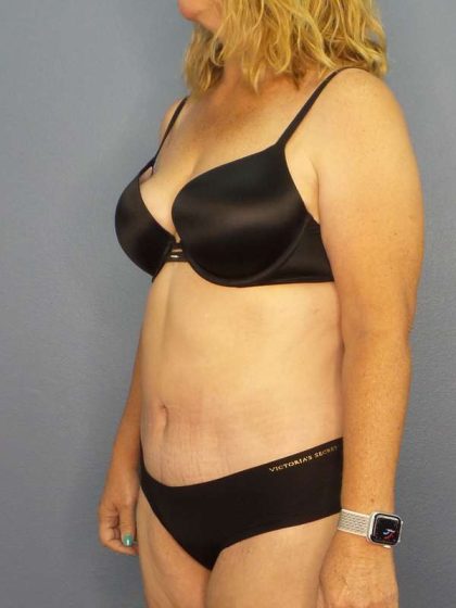 Abdominoplasty Before & After Patient #3398