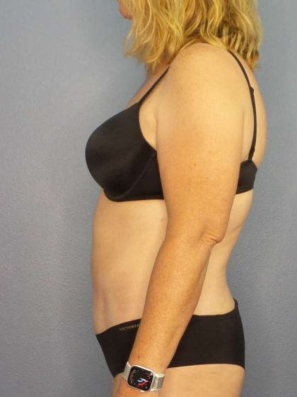 Abdominoplasty Before & After Patient #3398