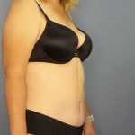 Abdominoplasty Before & After Patient #3398