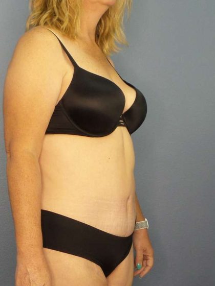 Abdominoplasty Before & After Patient #3398