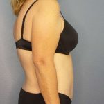 Abdominoplasty Before & After Patient #3398