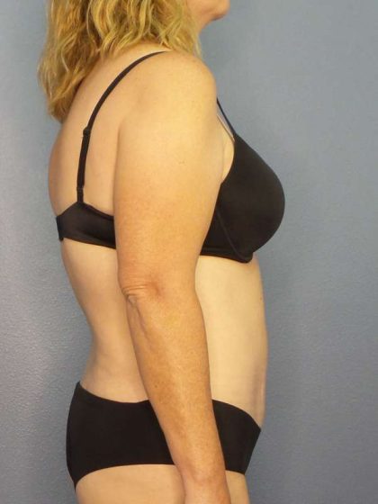 Abdominoplasty Before & After Patient #3398
