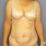 Abdominoplasty Before & After Patient #3398
