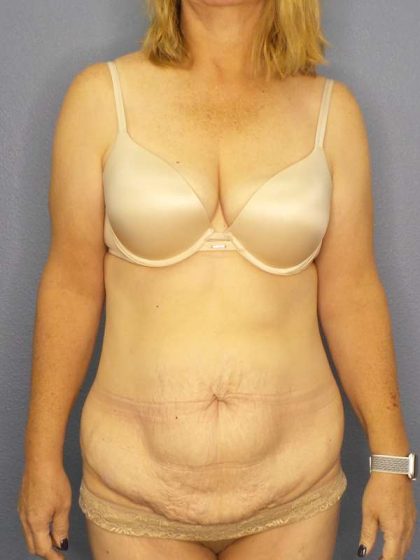 Abdominoplasty Before & After Patient #3398