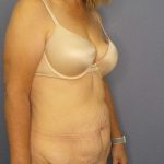 Abdominoplasty Before & After Patient #3398