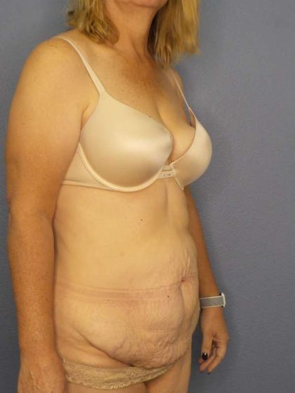 Abdominoplasty Before & After Patient #3398