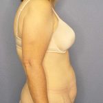 Abdominoplasty Before & After Patient #3398