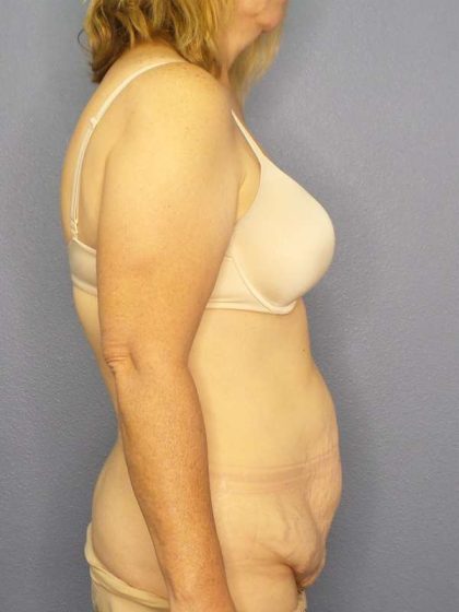 Abdominoplasty Before & After Patient #3398