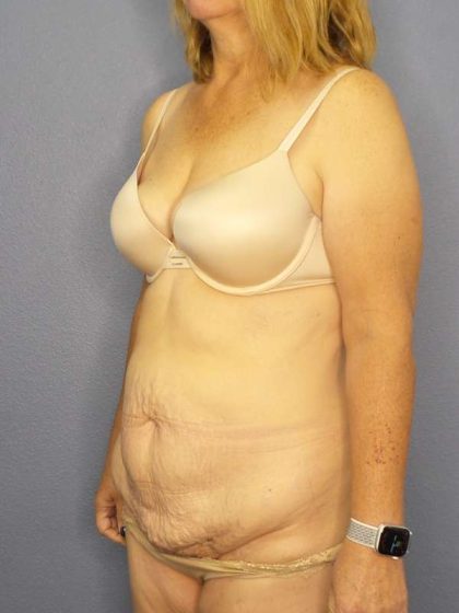 Abdominoplasty Before & After Patient #3398