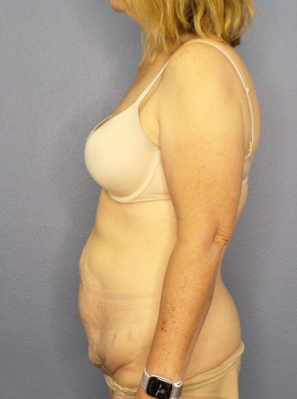 Abdominoplasty Before & After Patient #3398
