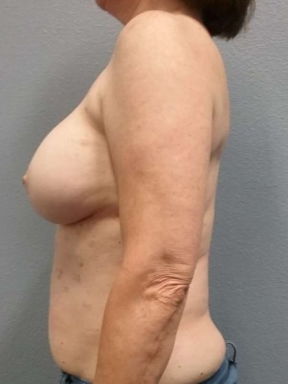 Breast Augmentation Revision (Breast Enlargement Repair) Before & After Patient #7314