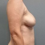 Breast Augmentation Revision (Breast Enlargement Repair) Before & After Patient #7314