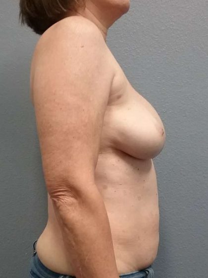 Breast Augmentation Revision (Breast Enlargement Repair) Before & After Patient #7314