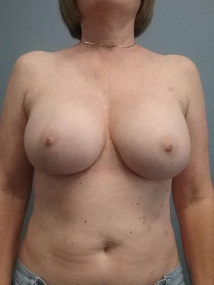 Breast Augmentation Revision (Breast Enlargement Repair) Before & After Patient #7314