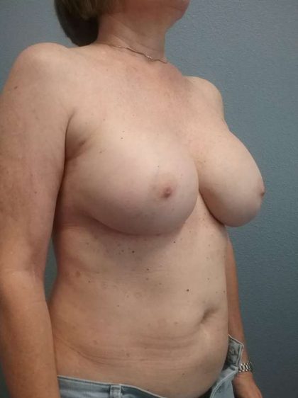 Breast Augmentation Revision (Breast Enlargement Repair) Before & After Patient #7314