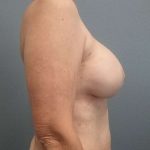 Breast Augmentation Revision (Breast Enlargement Repair) Before & After Patient #7314